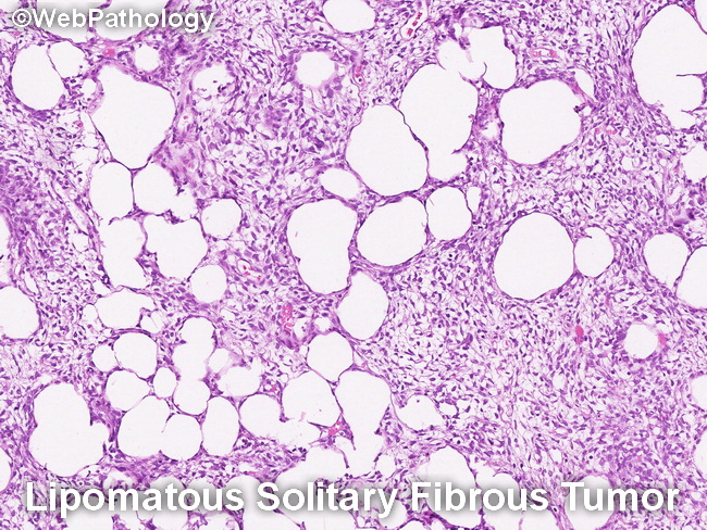 Lipomatous Solitary Fibrous Tumor.jpg